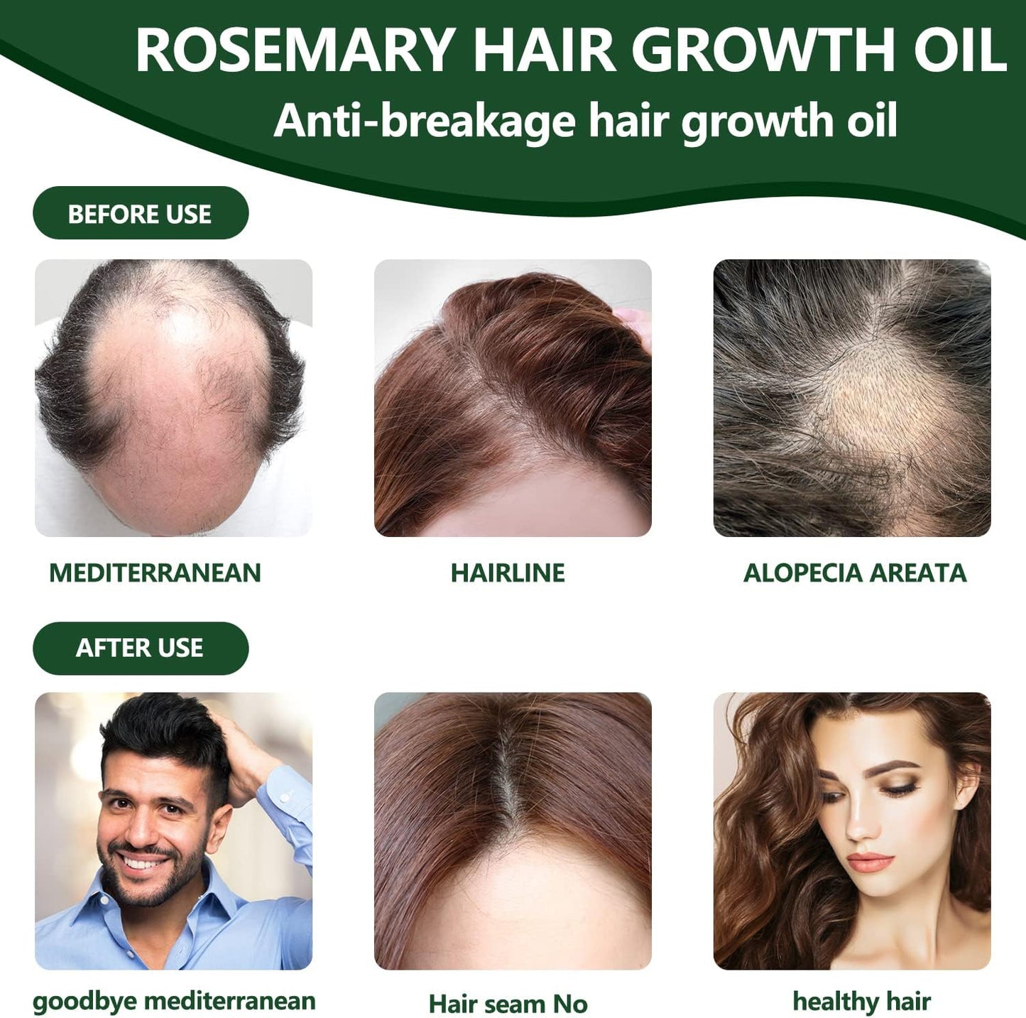 Rosemary Hair Growth Oil – Anti Hair Loss & Scalp Nourishing Solution